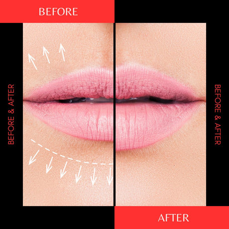 Bonafill Soft Premium Filler: A Revolutionary Solution for Skin Enhancement - Filler Lux™