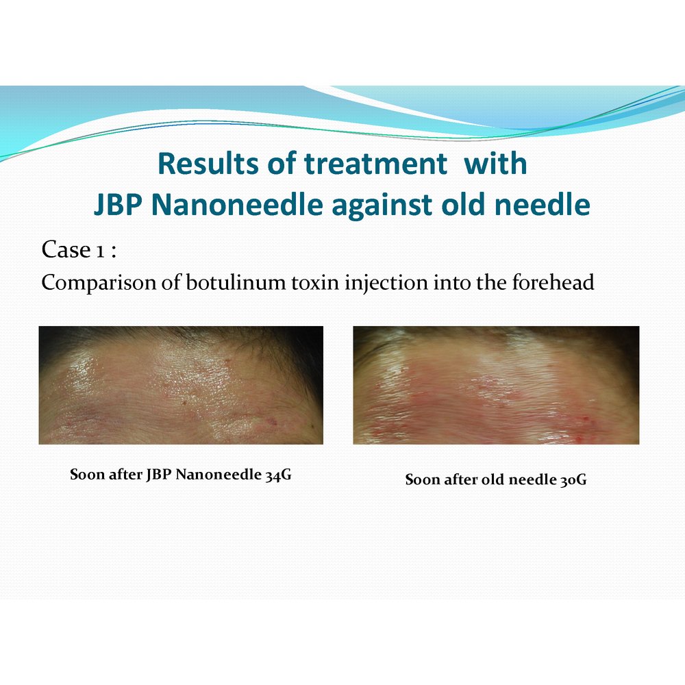 JBP Nanoneedle - Filler Lux™ - Needles - Japan Bio Products Co., Ltd.