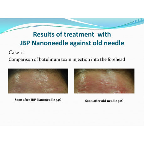 JBP Nanoneedle - Filler Lux™ - Needles - Japan Bio Products Co., Ltd.