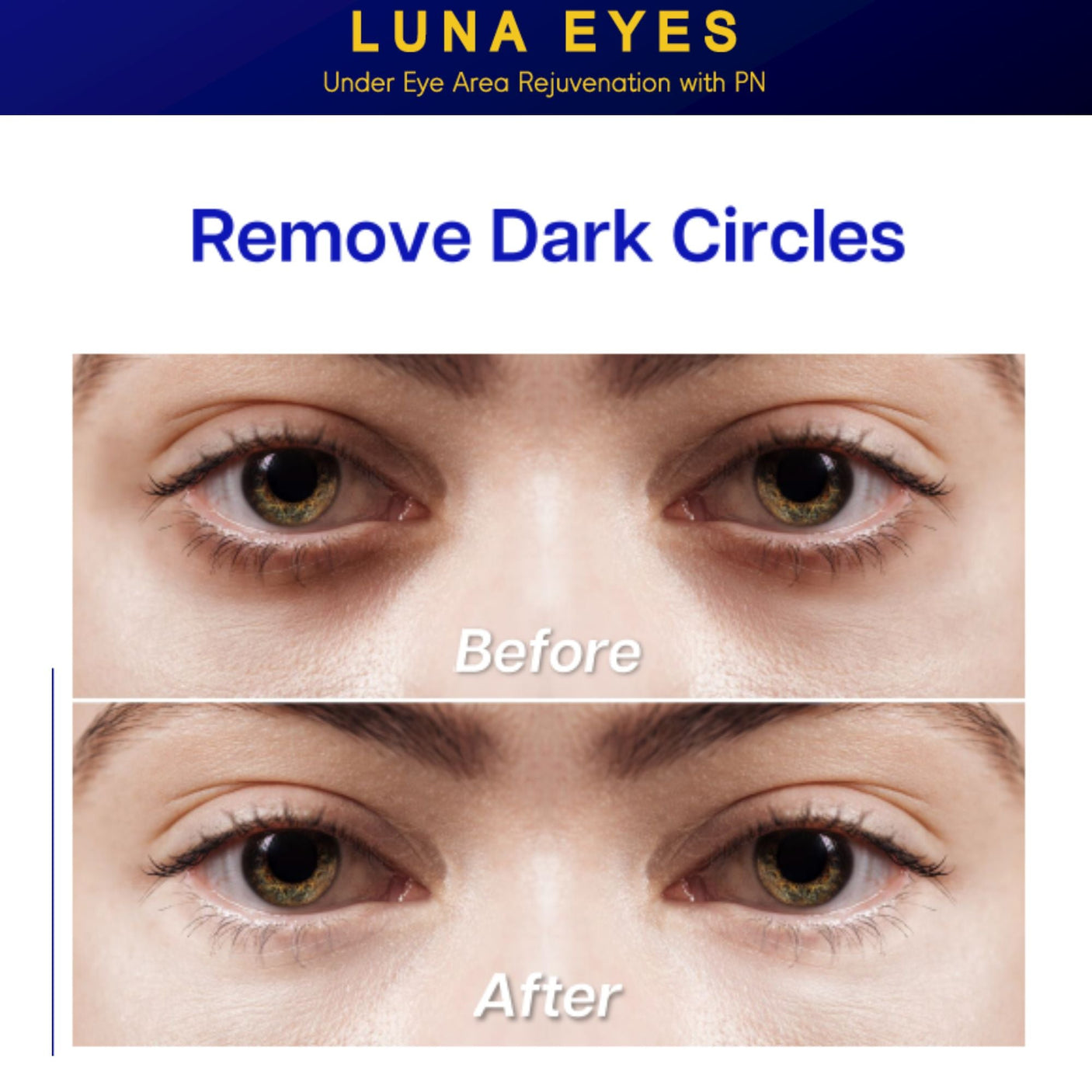 Luna Eyes Rejuvenation PN - Filler Lux™ - Mesotherapy - Let It beauty Co., Ltd.